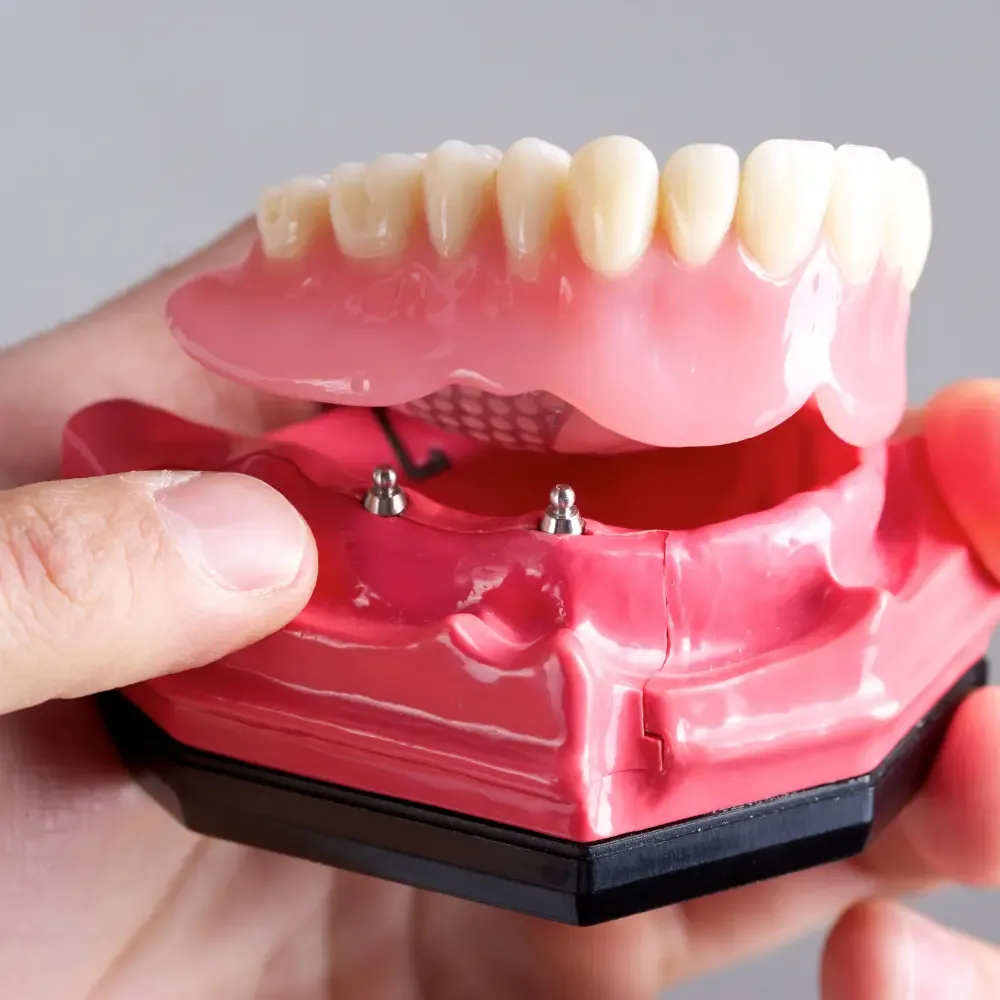 All-on-X implant-retained teeth for full-arch replacement in Toowoomba