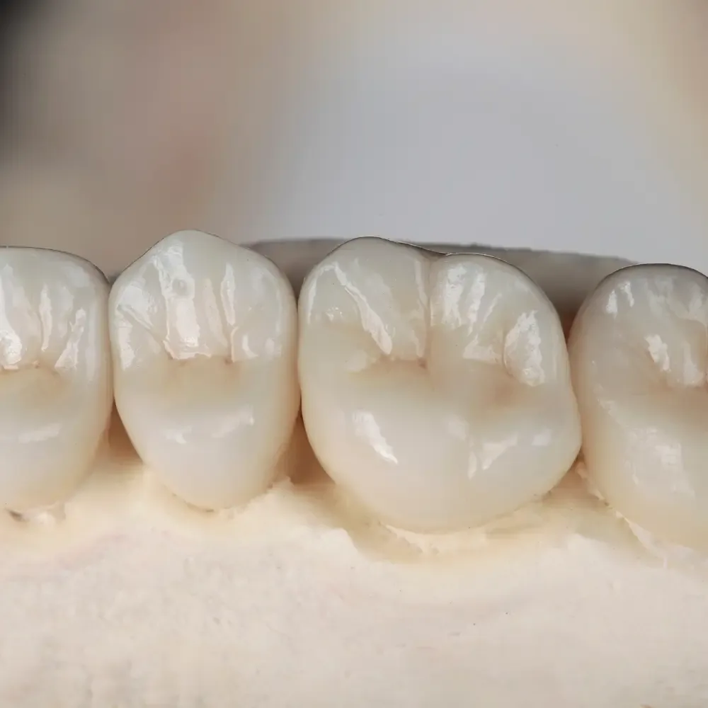 Ceramic dental crowns shaped and shaded to match natural teeth