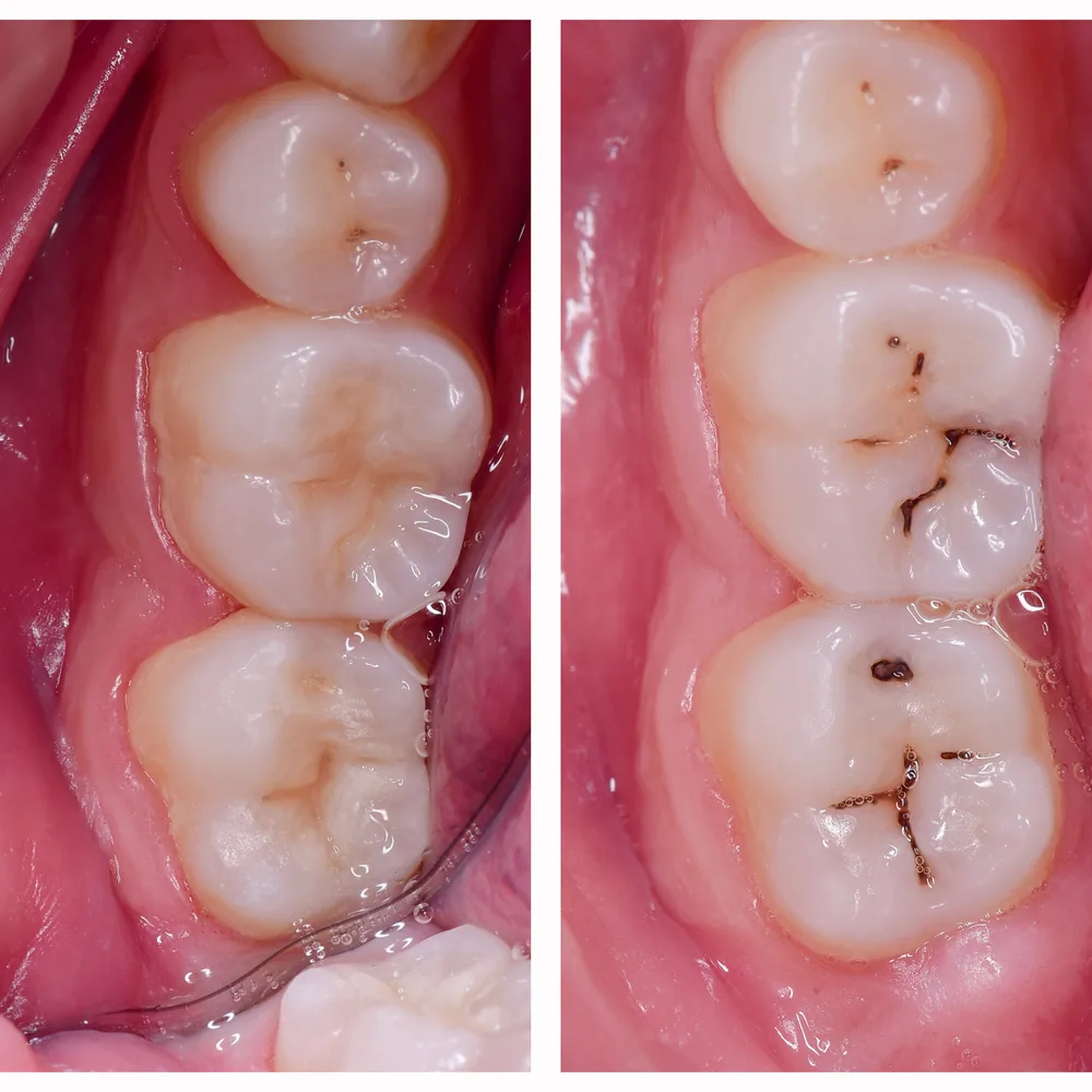 Tooth-coloured composite fillings shown before and after treatment