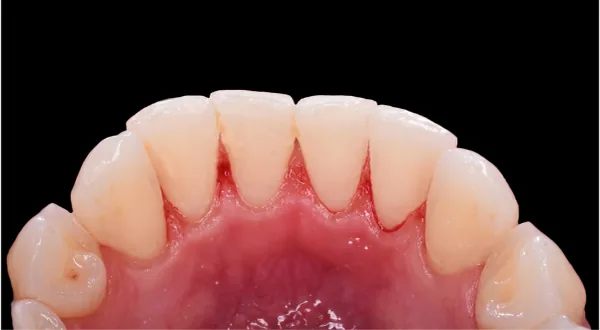 The same lower front teeth after a professional scale and clean, with tartar removed from along the gumline