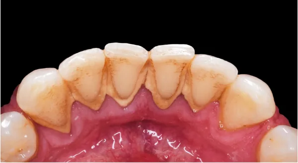Hardened tartar and staining built up along the gumline of the lower front teeth before a professional clean at Southside Dental Toowoomba